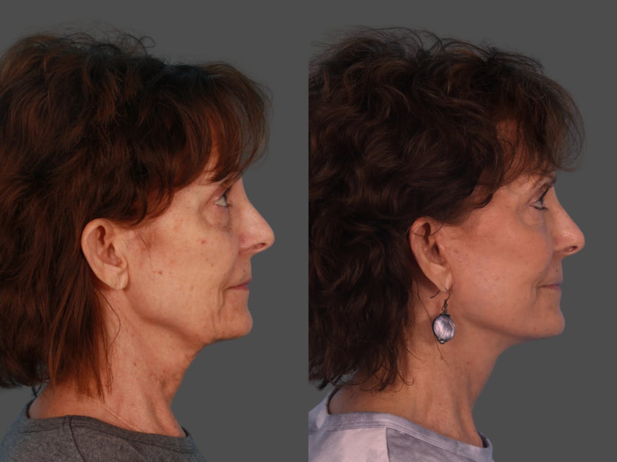 Limited Incision Facelift Before & After Gallery - Patient 307006 - Image 3