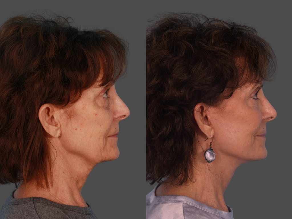 Limited Incision Facelift Before & After Gallery - Patient 307006 - Image 3