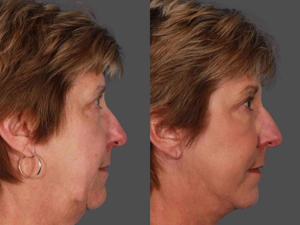 Limited Incision Facelift Before & After Gallery - Patient 269231 - Image 3