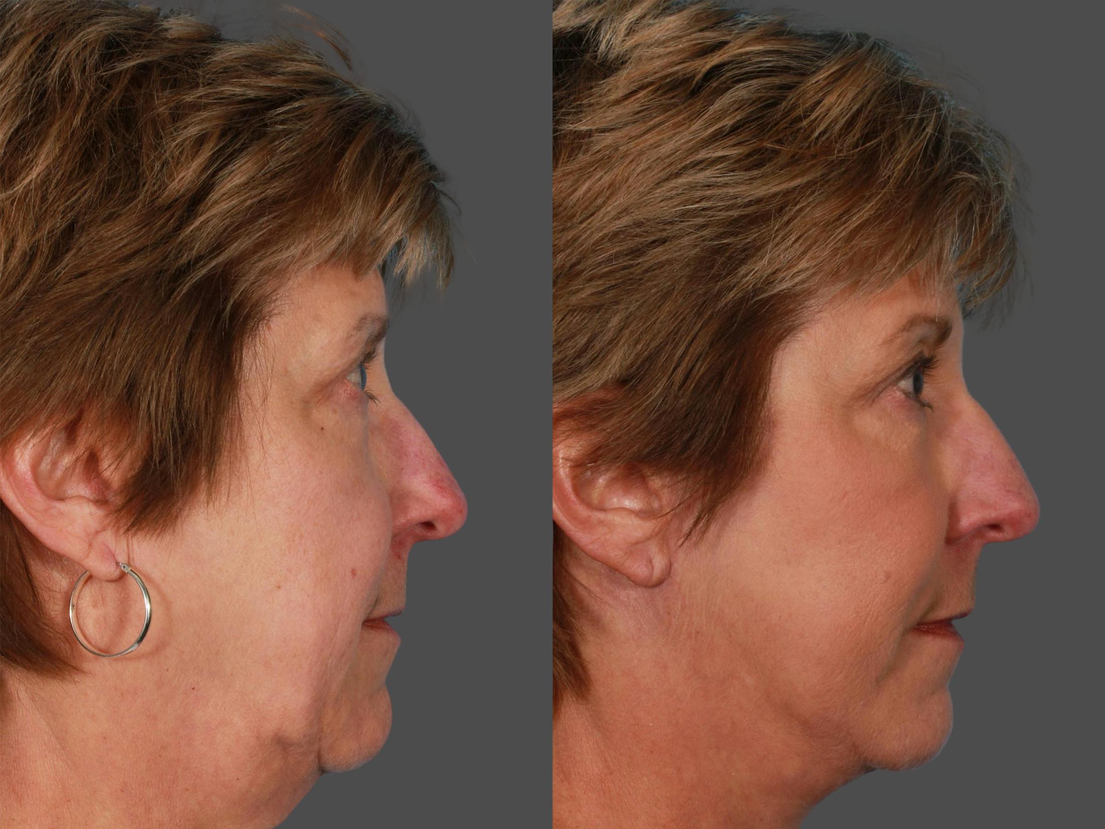 Limited Incision Facelift Before & After Gallery - Patient 269231 - Image 3