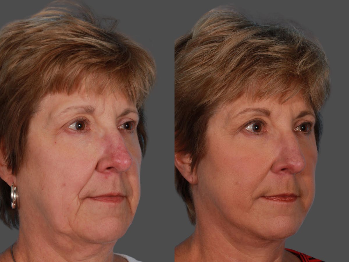 Limited Incision Facelift Before & After Gallery - Patient 269231 - Image 2