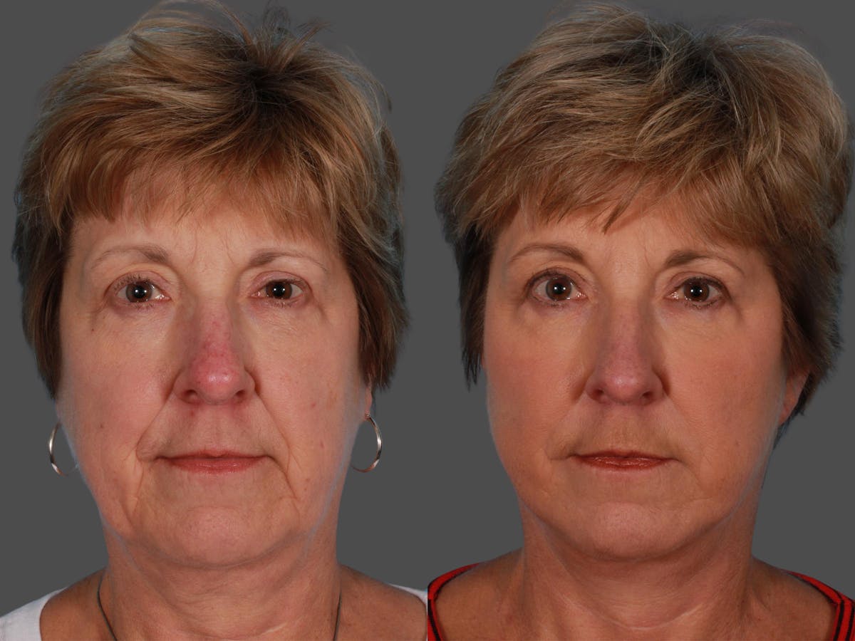 Limited Incision Facelift Before & After Gallery - Patient 269231 - Image 1