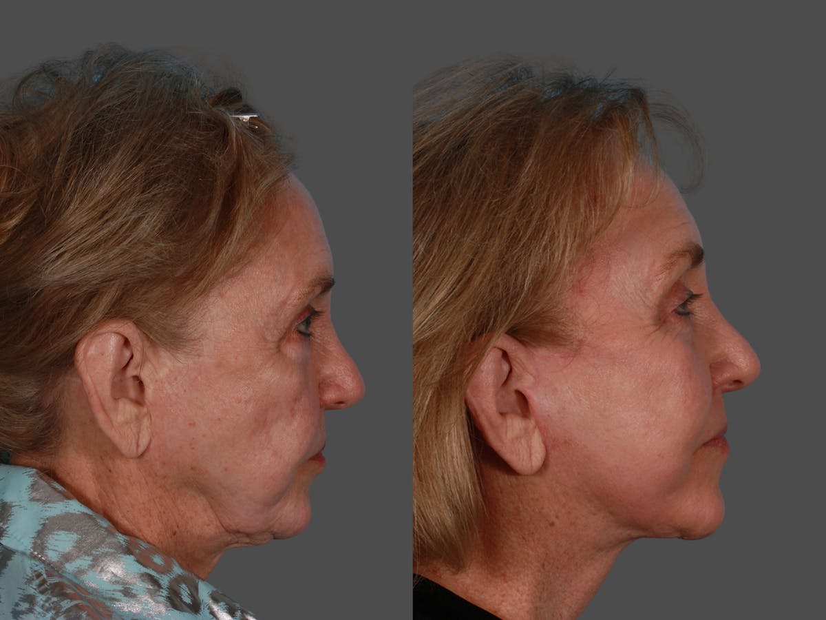 TCA Peel / Dermabrasion Before & After Gallery - Patient 341931 - Image 3