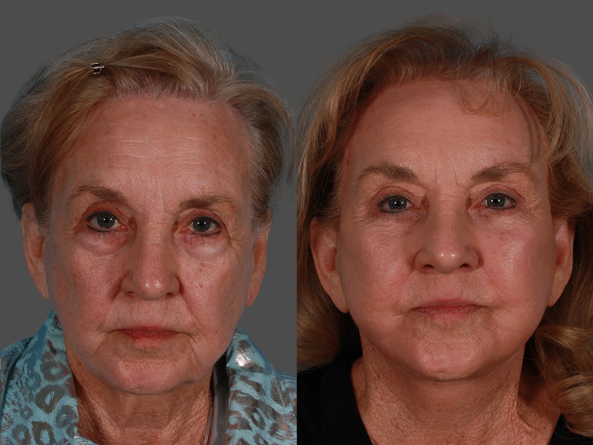 TCA Peel / Dermabrasion Before & After Gallery - Patient 341931 - Image 1