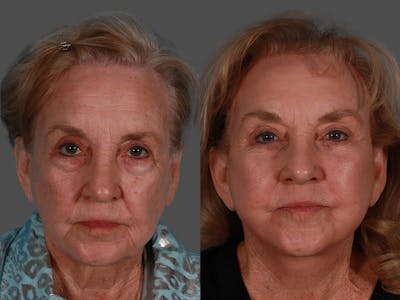 Limited Incision Facelift Before & After Gallery - Patient 348001 - Image 1