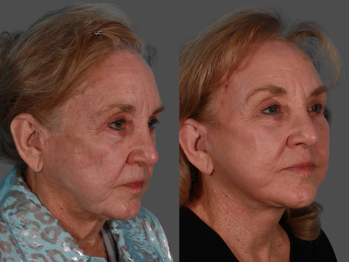 TCA Peel / Dermabrasion Before & After Gallery - Patient 341931 - Image 2