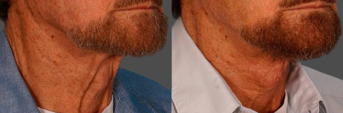 Neck Lift Before & After Gallery - Patient 399186 - Image 2