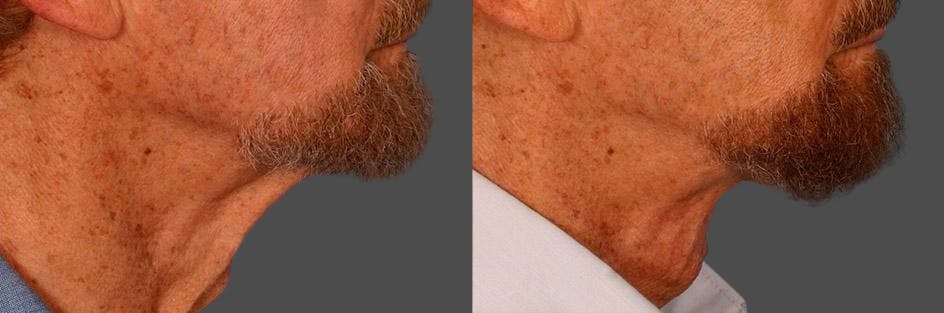 Neck Lift Before & After Gallery - Patient 399186 - Image 3