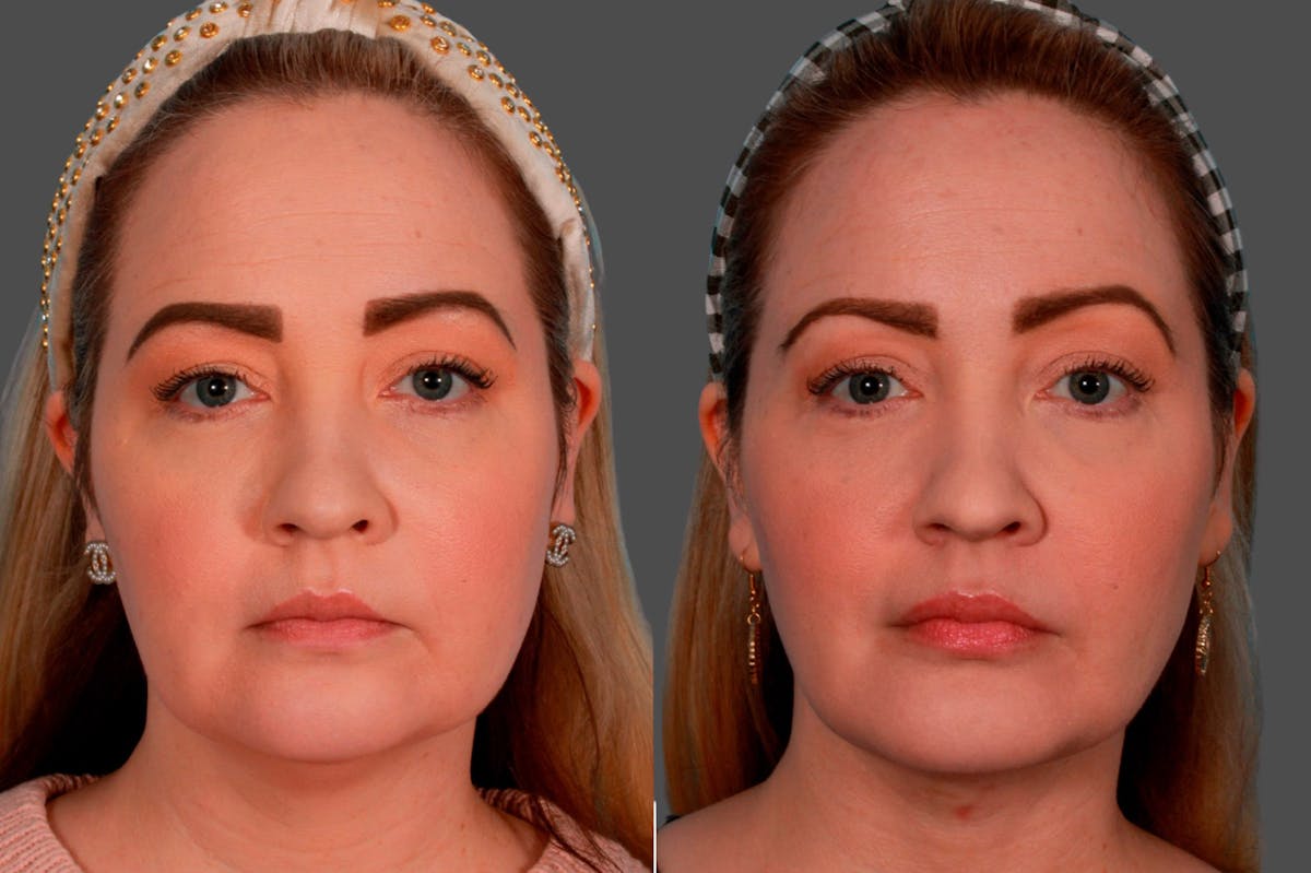 Neck Lift Before & After Gallery - Patient 387292 - Image 1