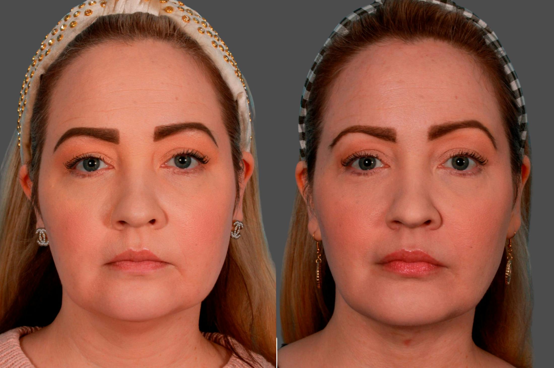 Neck Lift Before & After Gallery - Patient 387292 - Image 1