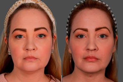 Neck Lift Before & After Gallery - Patient 387292 - Image 1