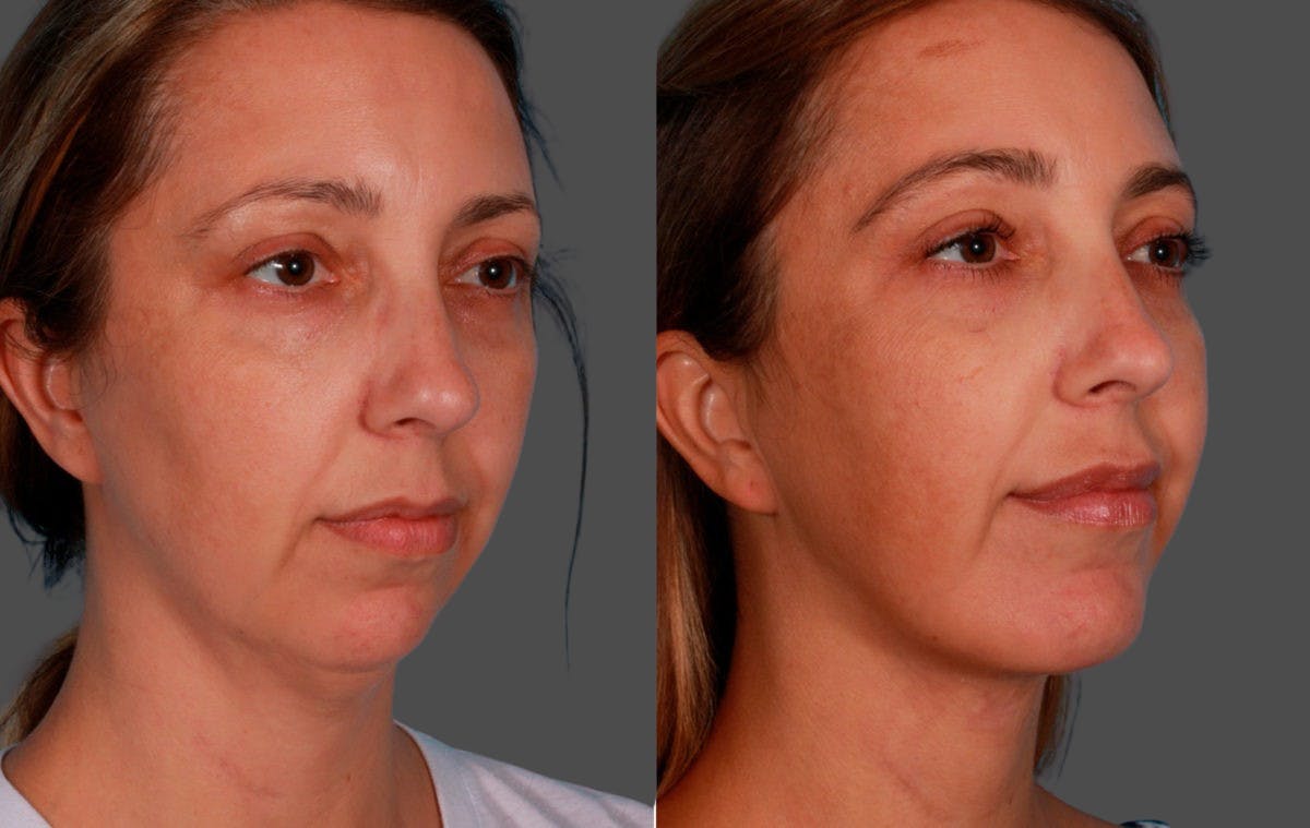 Neck Lift Before & After Gallery - Patient 214219 - Image 2