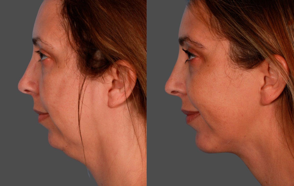 Neck Lift Before & After Gallery - Patient 214219 - Image 3