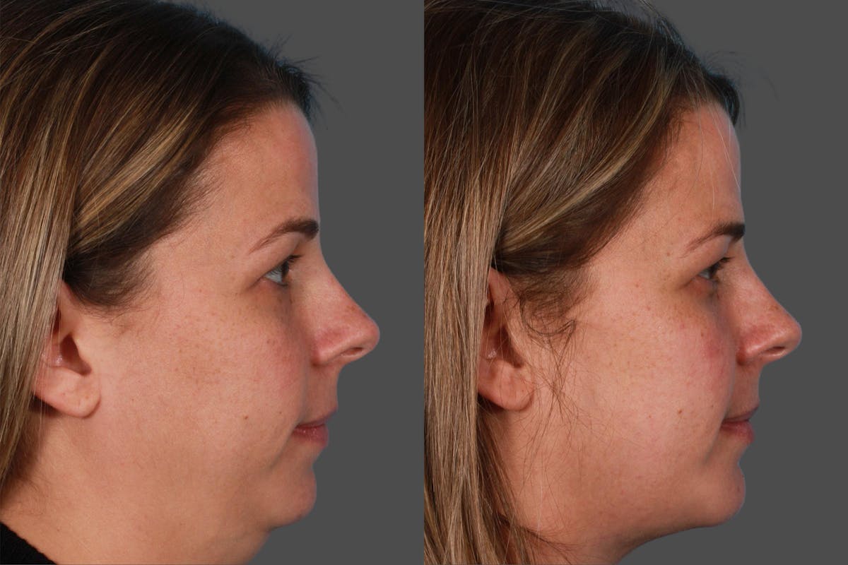 Neck Lift Before & After Gallery - Patient 310996 - Image 2
