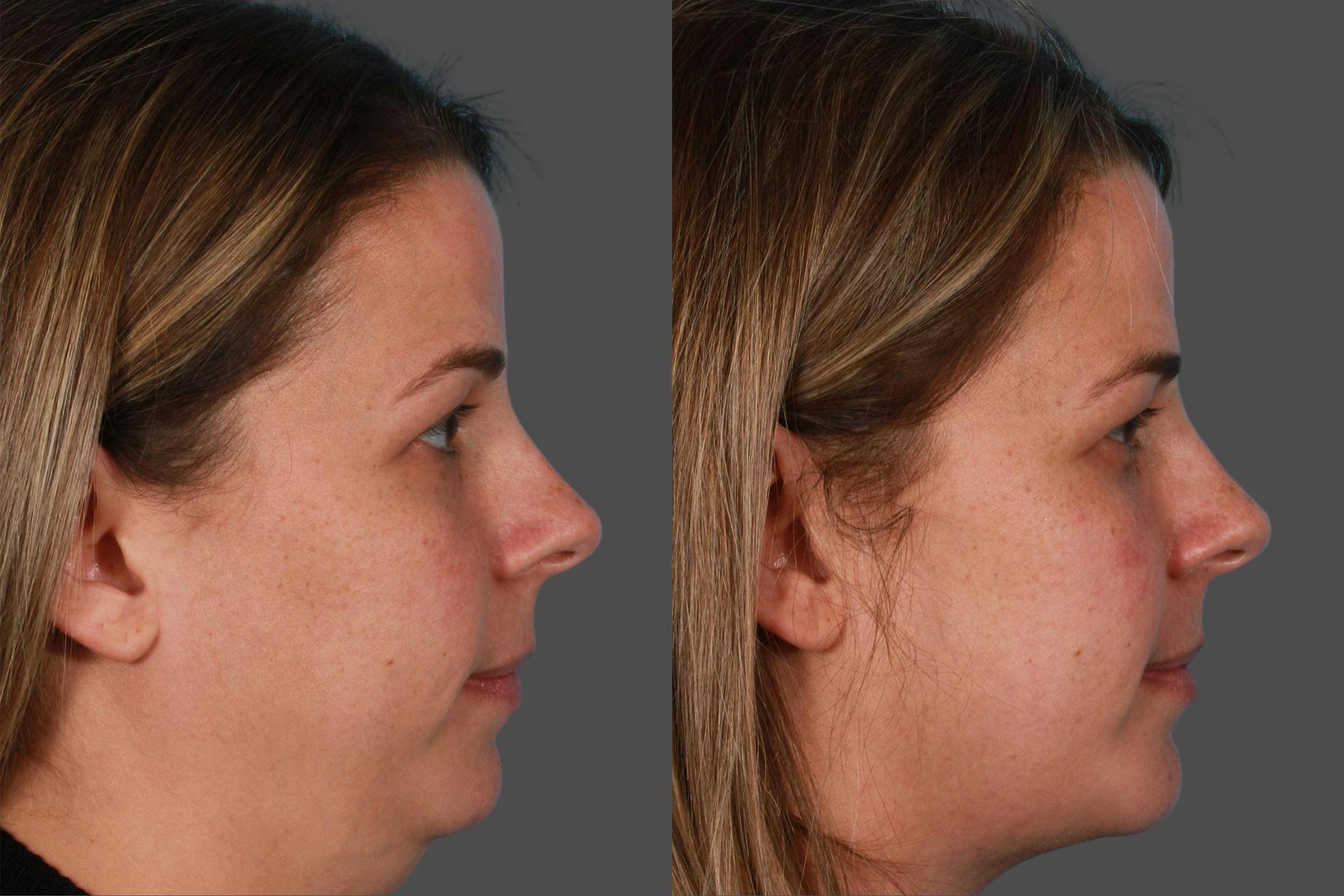 Neck Lift Before & After Gallery - Patient 310996 - Image 2