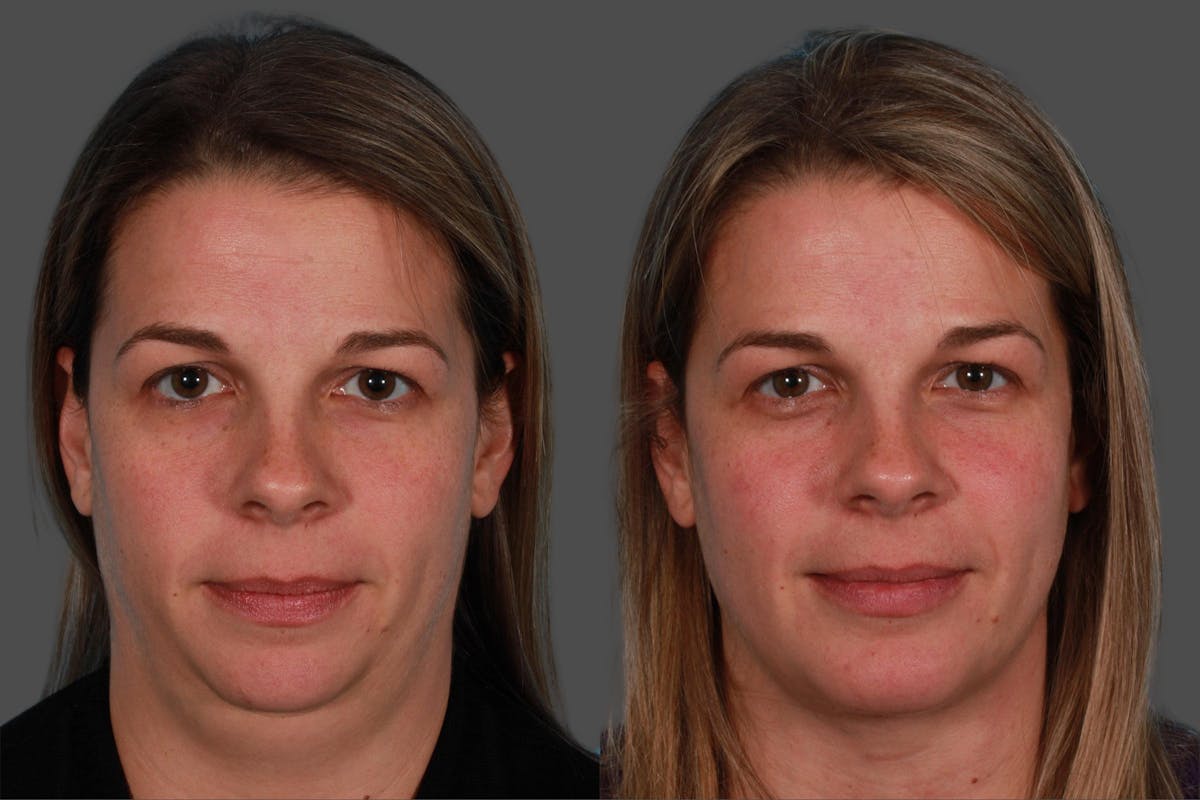 Neck Lift Before & After Gallery - Patient 310996 - Image 1
