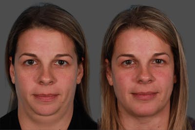 Neck Lift Before & After Gallery - Patient 310996 - Image 1