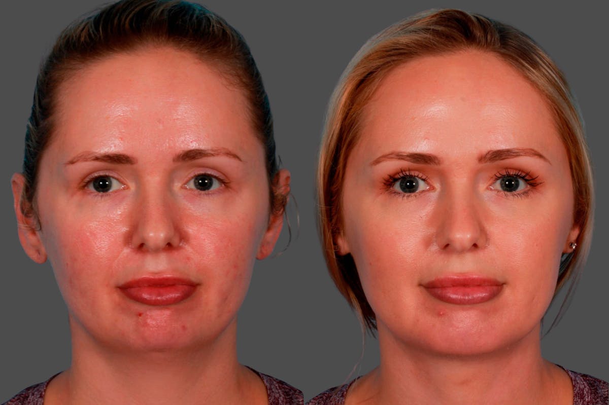 Neck Lift Before & After Gallery - Patient 139650 - Image 1