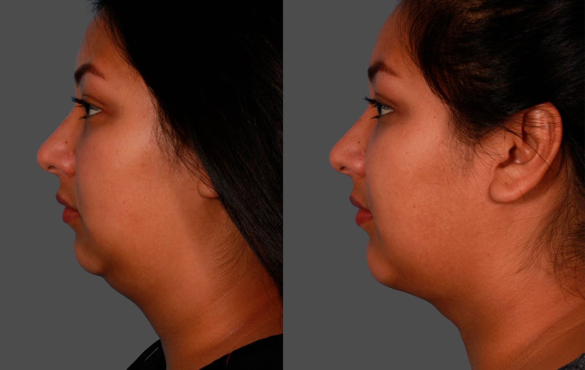 Neck Lift Before & After Gallery - Patient 139297 - Image 1