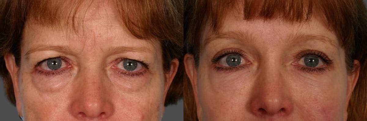 TCA Peel / Dermabrasion Before & After Gallery - Patient 366275 - Image 4