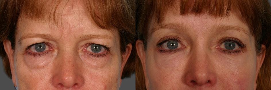 TCA Peel / Dermabrasion Before & After Gallery - Patient 366275 - Image 4