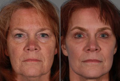 TCA Peel / Dermabrasion Before & After Gallery - Patient 958769 - Image 1