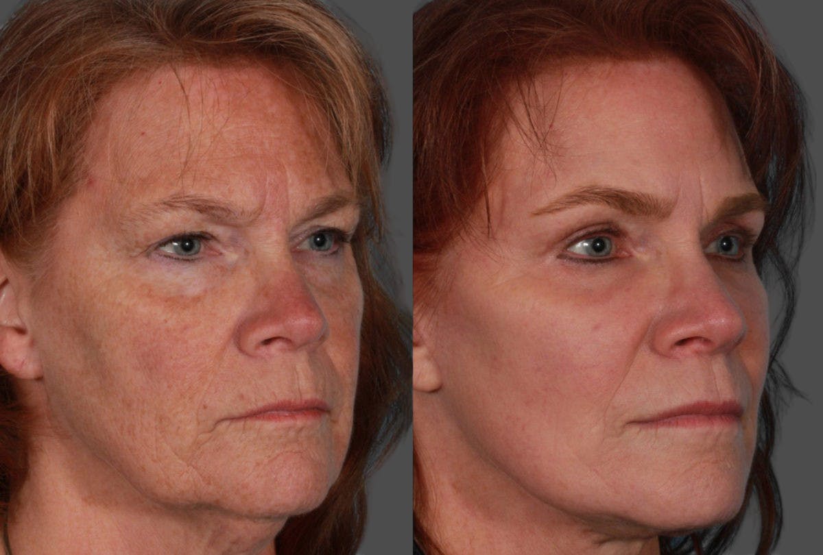 TCA Peel / Dermabrasion Before & After Gallery - Patient 958769 - Image 2