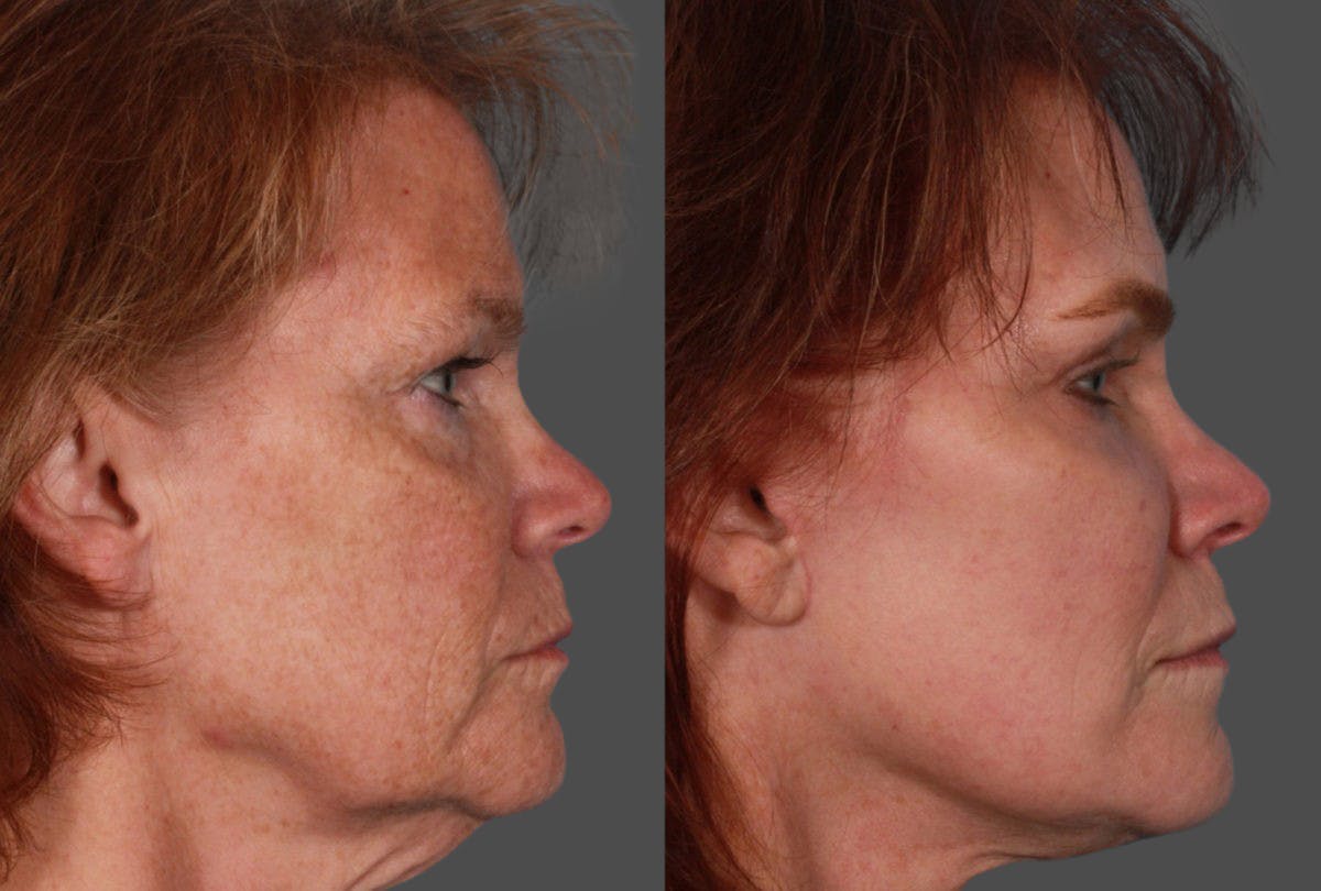 TCA Peel / Dermabrasion Before & After Gallery - Patient 958769 - Image 3