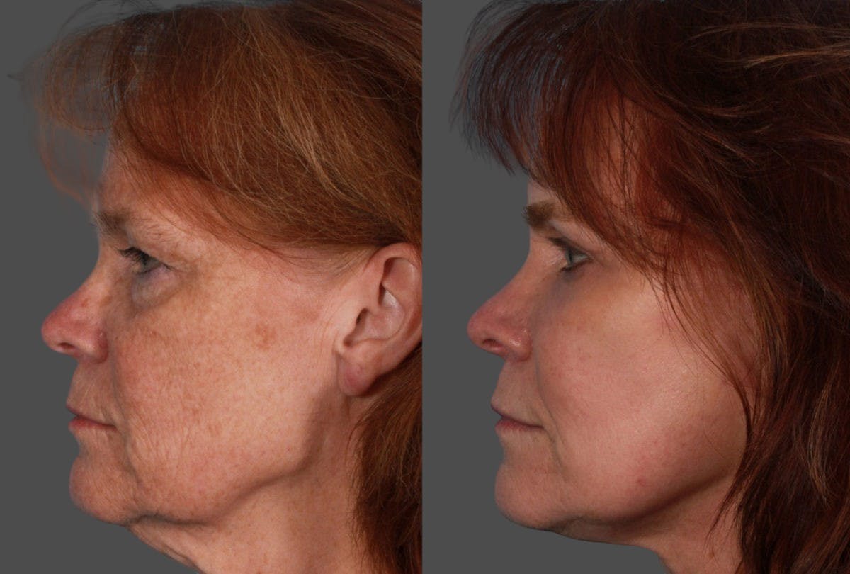 TCA Peel / Dermabrasion Before & After Gallery - Patient 958769 - Image 4