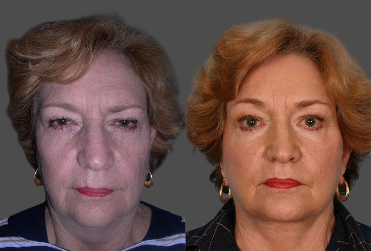 TCA Peel / Dermabrasion Before & After Gallery - Patient 683228 - Image 1