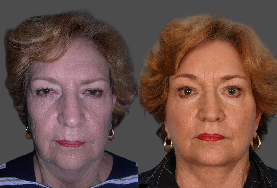 TCA Peel / Dermabrasion Before & After Gallery - Patient 683228 - Image 1