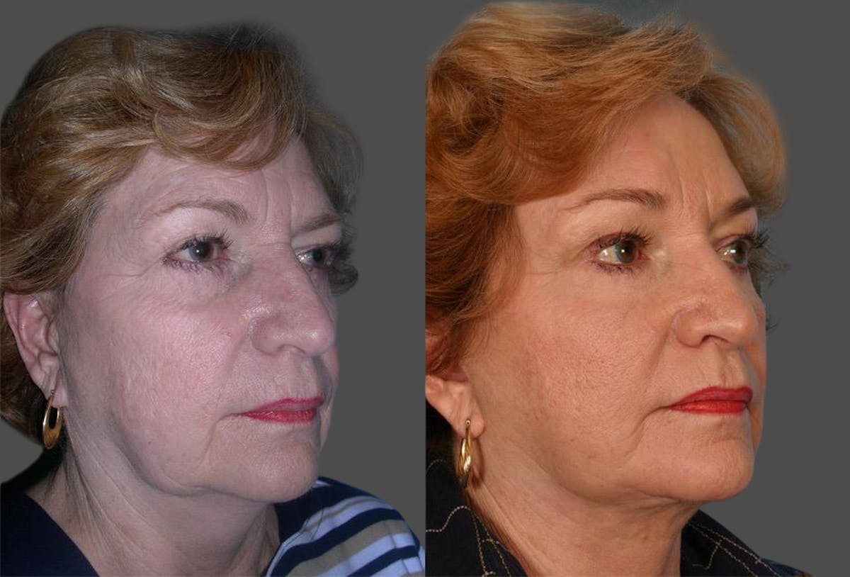 TCA Peel / Dermabrasion Before & After Gallery - Patient 683228 - Image 2