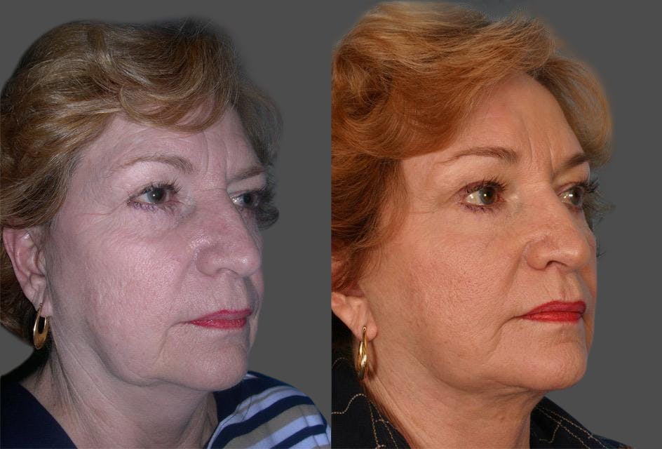 TCA Peel / Dermabrasion Before & After Gallery - Patient 683228 - Image 2