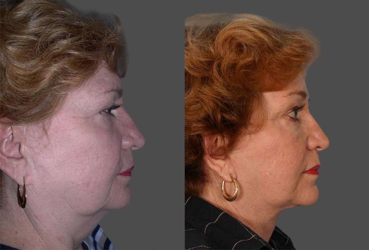 TCA Peel / Dermabrasion Before & After Gallery - Patient 683228 - Image 3
