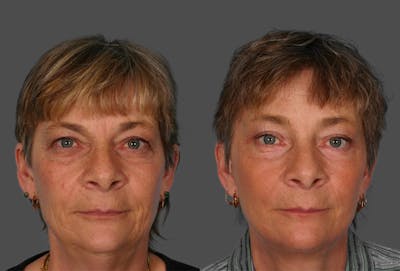 TCA Peel / Dermabrasion Before & After Gallery - Patient 423518 - Image 1