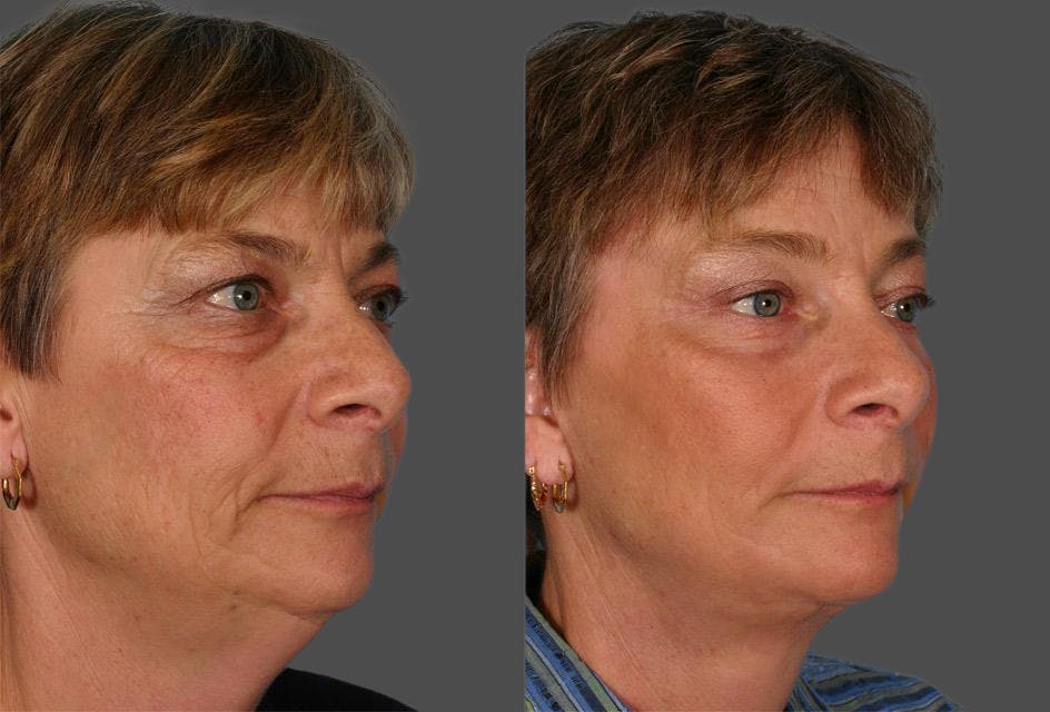 TCA Peel / Dermabrasion Before & After Gallery - Patient 423518 - Image 2