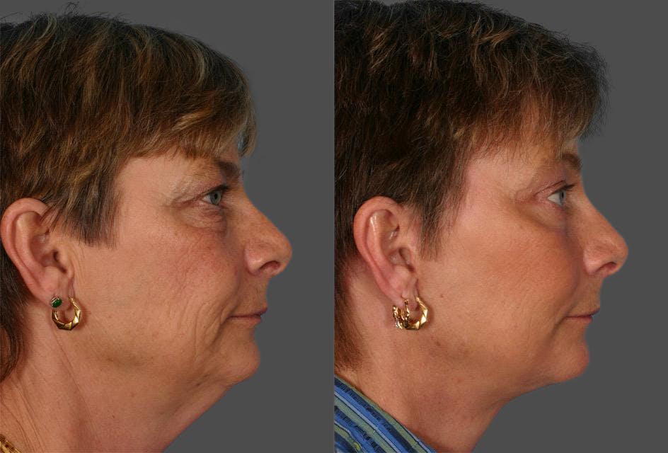 TCA Peel / Dermabrasion Before & After Gallery - Patient 423518 - Image 3