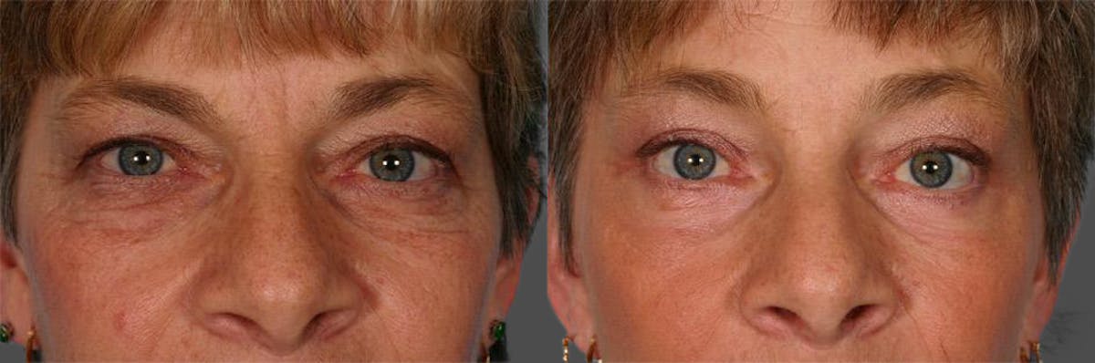 TCA Peel / Dermabrasion Before & After Gallery - Patient 423518 - Image 4