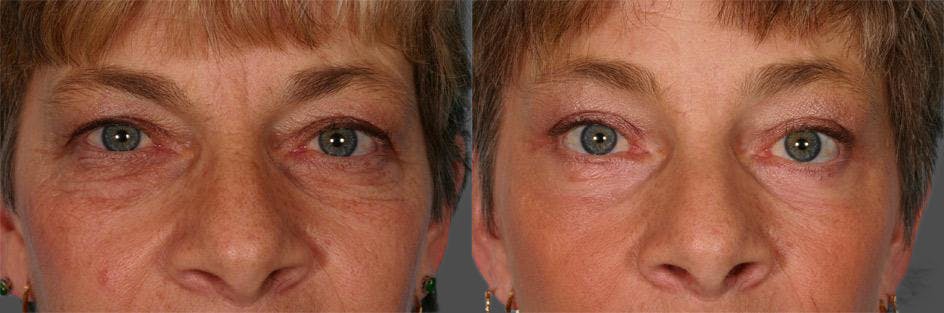 TCA Peel / Dermabrasion Before & After Gallery - Patient 423518 - Image 4