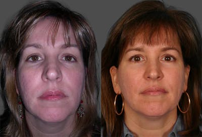 TCA Peel / Dermabrasion Before & After Gallery - Patient 416418 - Image 1