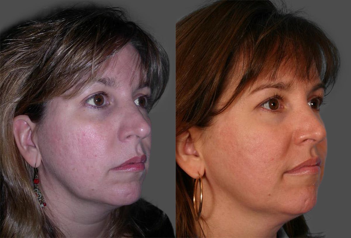 TCA Peel / Dermabrasion Before & After Gallery - Patient 416418 - Image 2