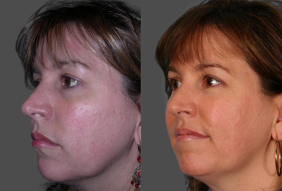 TCA Peel / Dermabrasion Before & After Gallery - Patient 416418 - Image 3