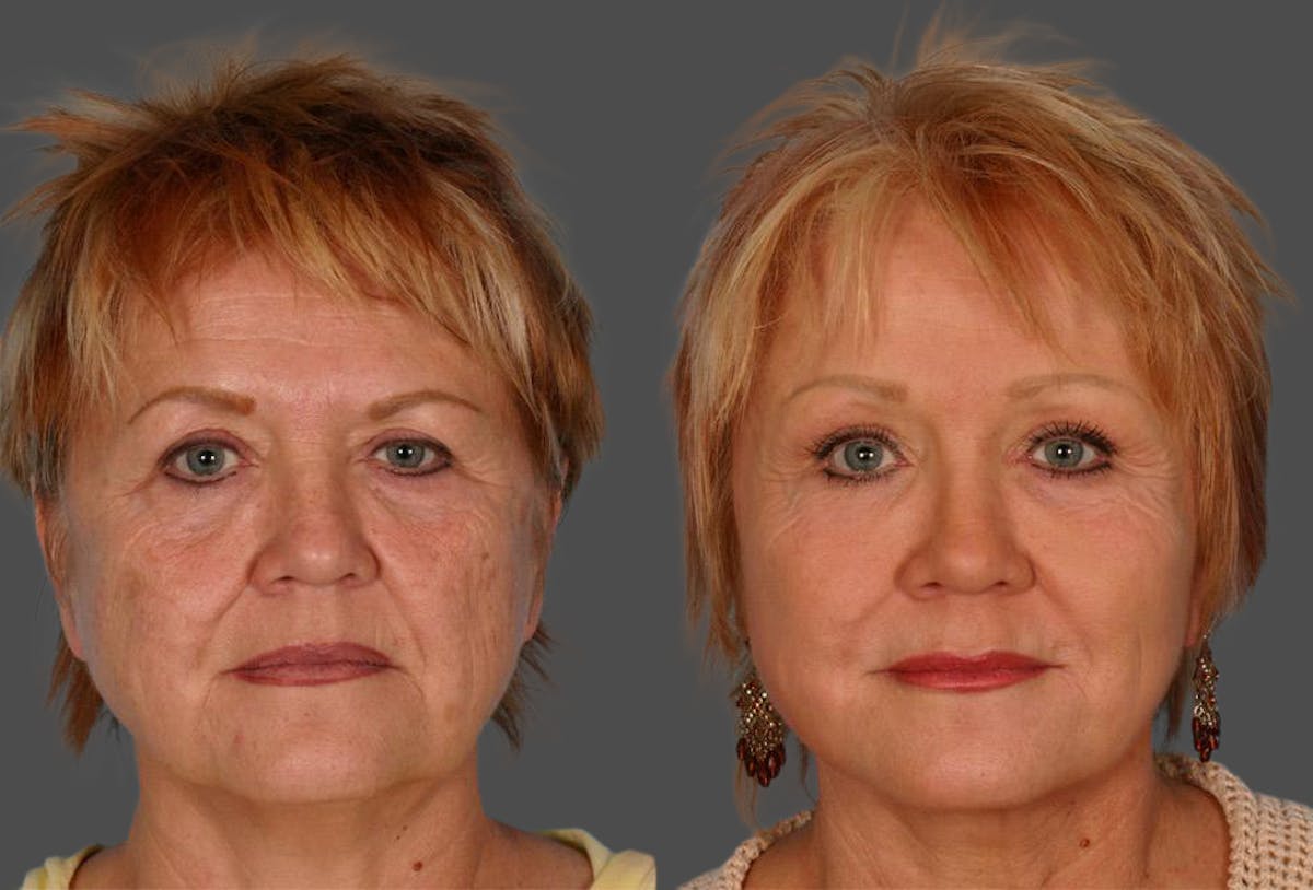 TCA Peel / Dermabrasion Before & After Gallery - Patient 379329 - Image 1