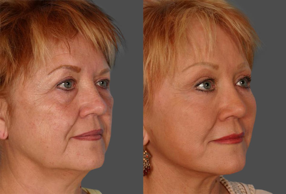 TCA Peel / Dermabrasion Before & After Gallery - Patient 379329 - Image 2