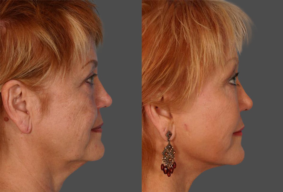 TCA Peel / Dermabrasion Before & After Gallery - Patient 379329 - Image 3
