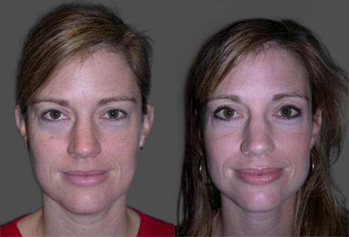 TCA Peel / Dermabrasion Before & After Gallery - Patient 326529 - Image 1
