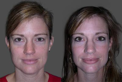 TCA Peel / Dermabrasion Before & After Gallery - Patient 326529 - Image 1