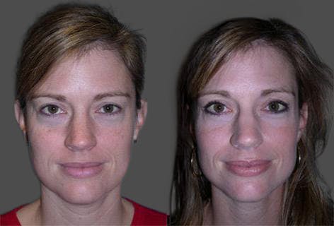 TCA Peel / Dermabrasion Before & After Gallery - Patient 326529 - Image 1
