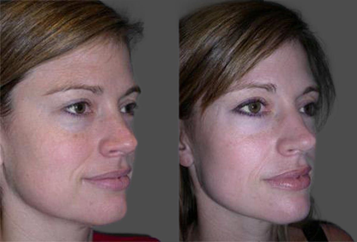 TCA Peel / Dermabrasion Before & After Gallery - Patient 326529 - Image 2