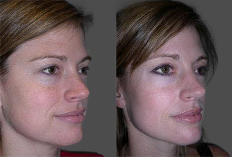 TCA Peel / Dermabrasion Before & After Gallery - Patient 326529 - Image 2